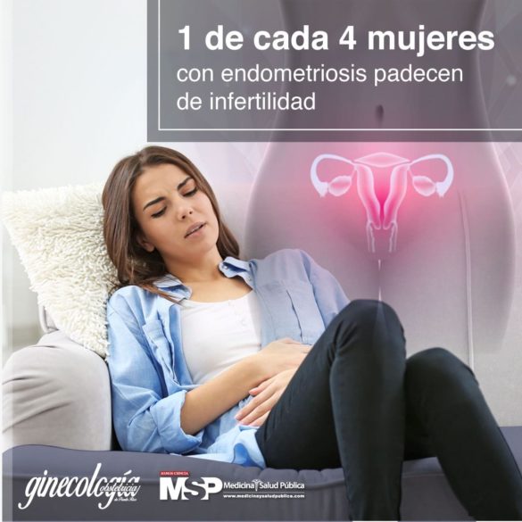 La endometriosis es una de las causas de infertilidad en mujeres